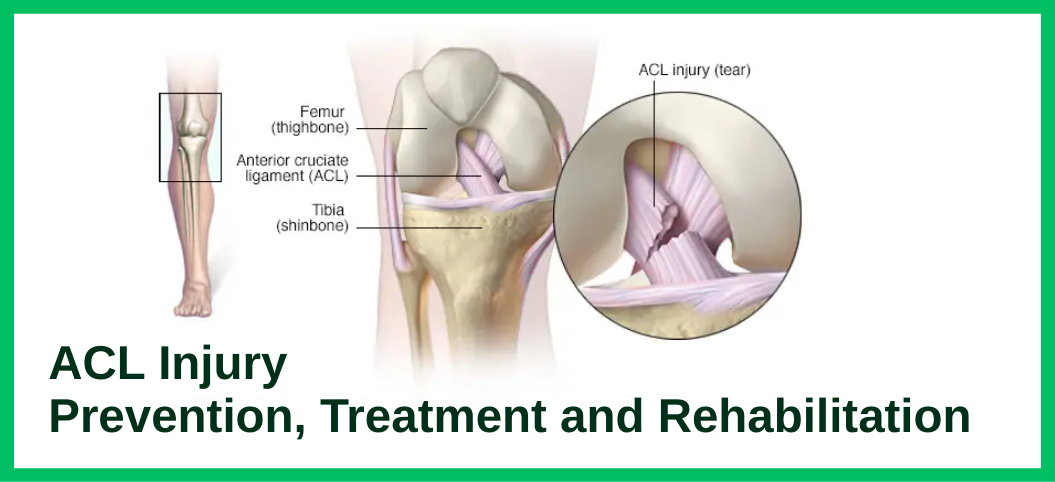 ACL Injury: Prevention, Treatment and Rehabilitation