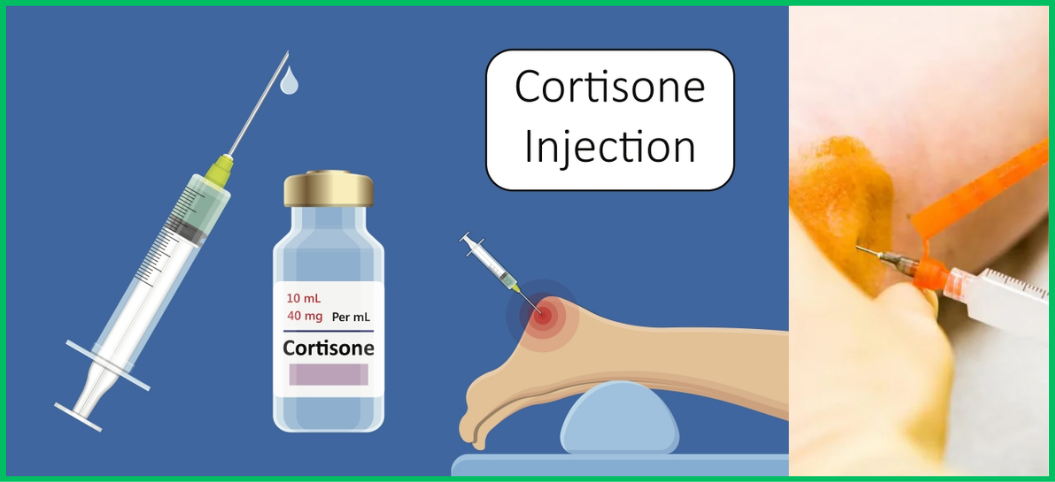 Cortisone Injections: Myths and Facts