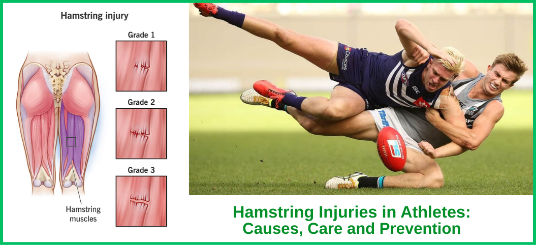 Hamstring Injuries in Athletes: Causes, Care and Prevention