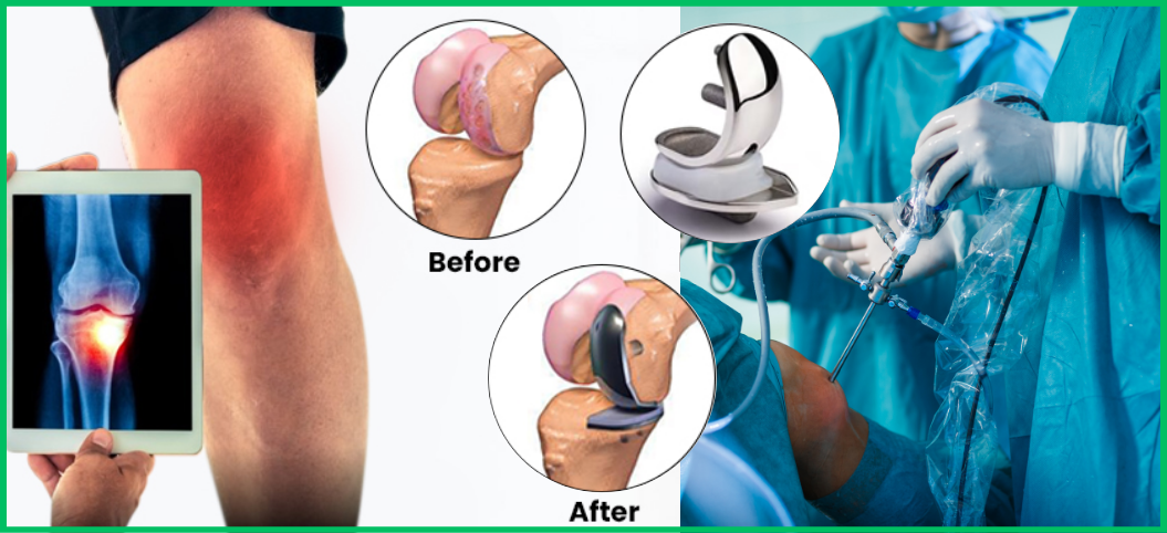 Innovations in Partial Knee Replacement Surgery at 5 Sports Health