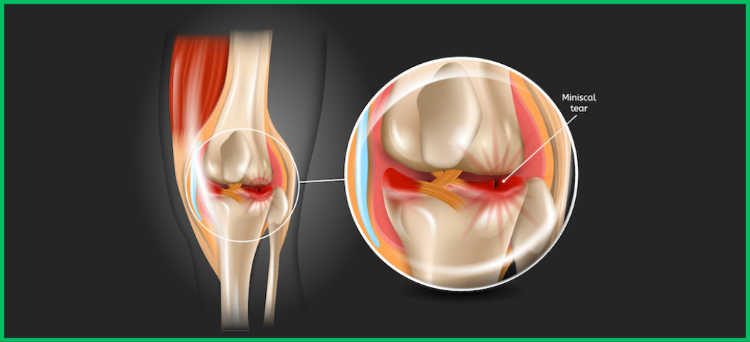 Understanding Meniscus Repair Options: Surgical vs. Non-Surgical Paths