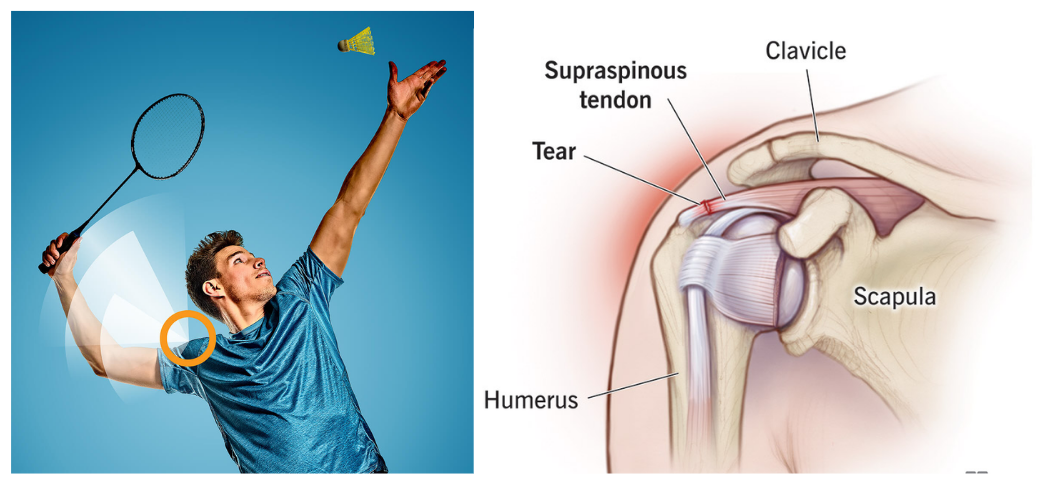 Tailored Rehabilitation Plans for Shoulder Injuries in Racquet Sports
