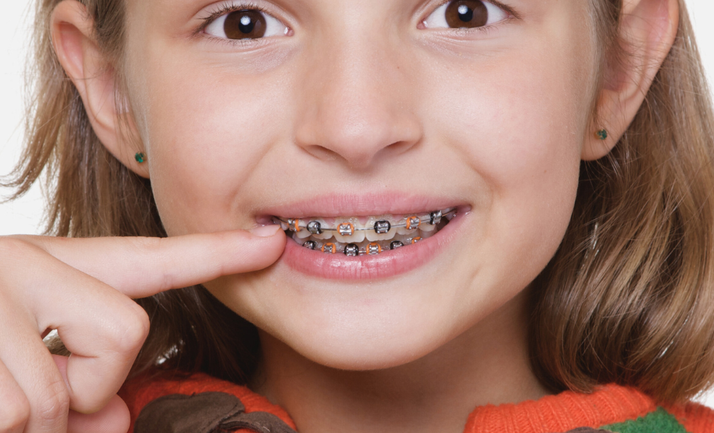 How Long Will My Child Wear Braces?
