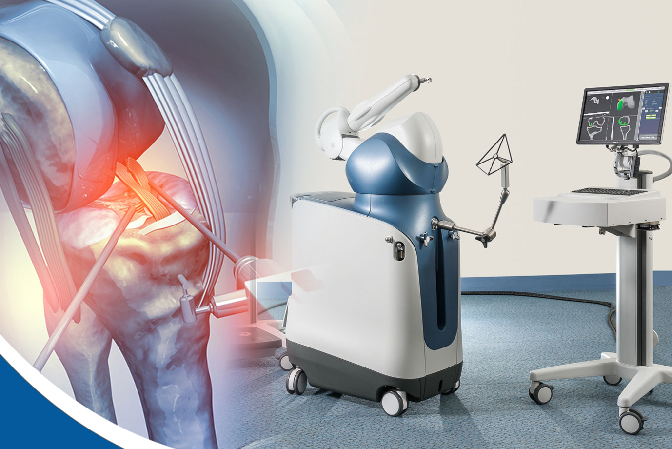 Precision Beyond Human Hands: Robotic Knee Replacement